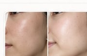 Facial contouring before and after